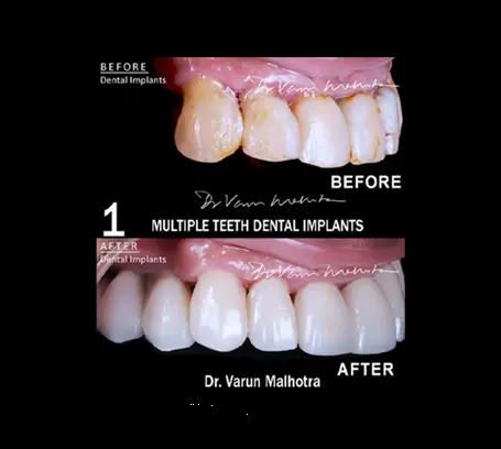 Implant-supported fixed bridge for multiple missing teeth — partial mouth rehabilitation Mumbai India PRAXIS Dental